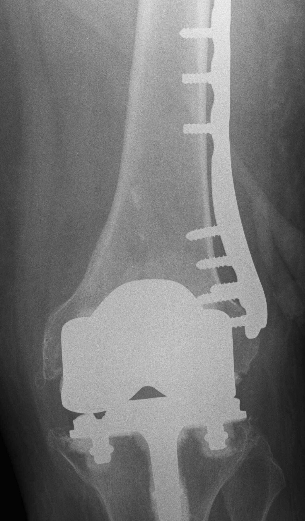 TKR Periprosthetic Fracture Locking Plate AP